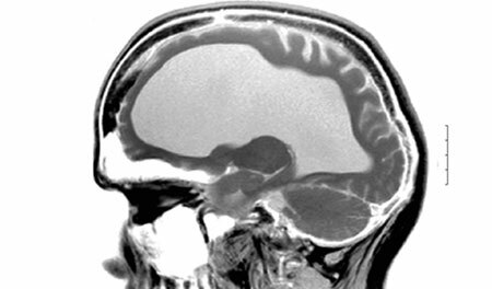 Hidrocefalia interna do cérebro