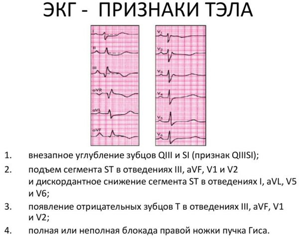 PE on ECG. Signs, photos, what it is, treatment