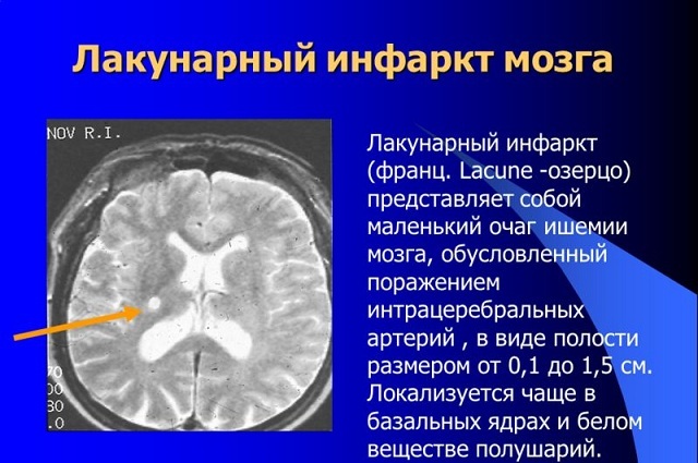 Leukoareosis of the brain - it's scary and dangerous