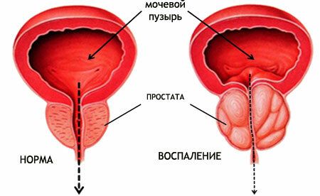 Prostatite crônica: sinais, tratamento e pílulas, sintomas de exacerbação