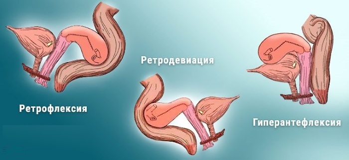 Retrodeviation of the uterus. What is it, degrees, how to treat, get pregnant