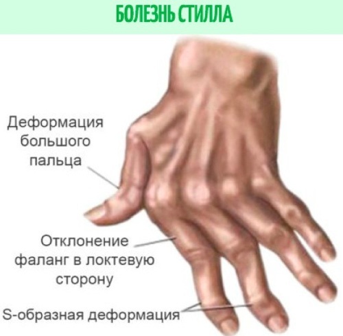 Wandering pain all over the body. Causes in joints, muscles