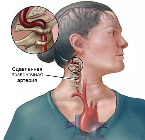 VBN diagnosis in neurology. What is vertebrobasilar insufficiency, treatment