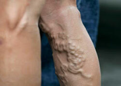 Surgical treatment of varicose veins