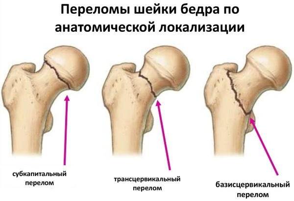 cuello del fémur. ¿Dónde está la persona, los síntomas de la fractura, fracturas, necrosis, dislocación, tratamiento, cirugía, rehabilitación