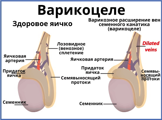 De zaadbal doet pijn aan de rechterkant, aan de linkerkant bij mannen, trekt aan de onderbuik. Oorzaken, behandeling