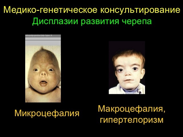 Macrocephaly - an abnormal increase in the mass and volume of the brain