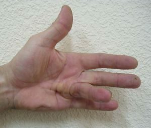 Dupuytren's contracture: surgery or treatment without surgery?