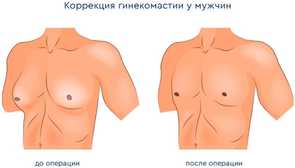 Surgery to remove gynecomastia in men. Price as it goes