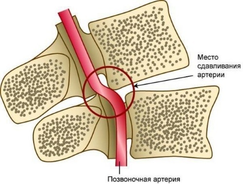 Vertebral cervicalgia. What is it, how to treat with muscle-tonic, myofascial, pain syndrome