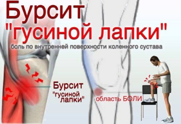 Gęsia stopa stawu kolanowego. Co to jest, anatomia, leczenie