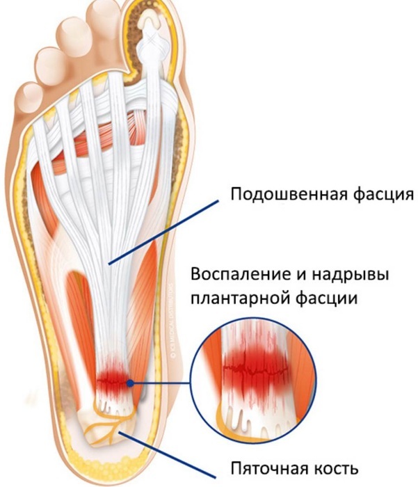 Plantar Fasciitis. Symptoms and treatment at home. Folk remedies, exercises, insoles, drugs