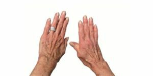 artrite reumatóide das mãos