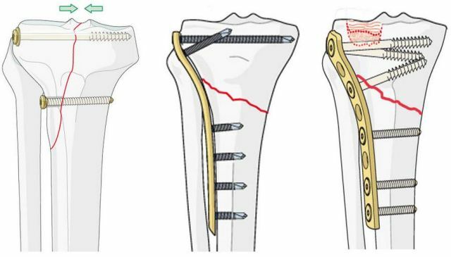 osteosynthesis of the tibia