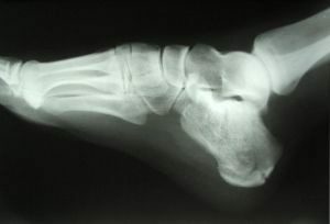 Röntgenfoto van de voet