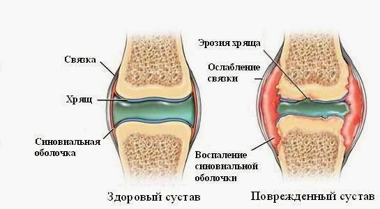 Uma articulação e articulação saudáveis ​​com artrite reumatóide