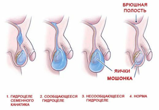 Waterzucht van testikels