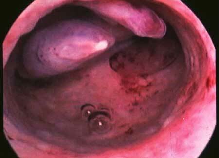 Endometrial polyp