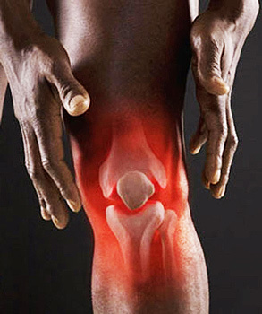 Arthritis dritten Grades des Kniegelenks