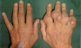 Arthritis can cause disability