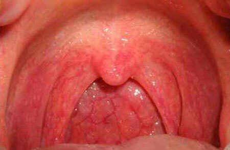 Photo of the throat with catarrhal angina
