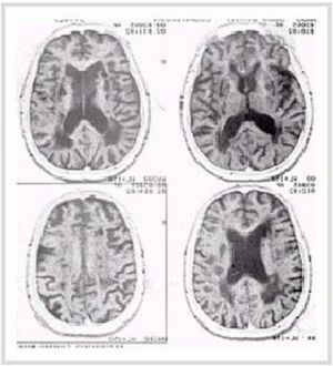 Marth of the brain affected by syphilis