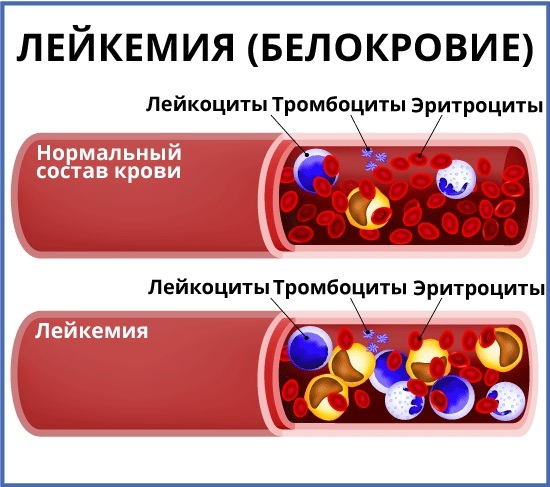 Leukemia. Gejala pada orang dewasa, anak-anak, tes darah, pengobatan dengan obat tradisional, obat-obatan