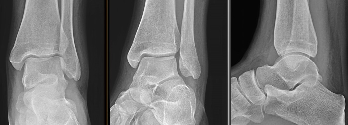 Ankle X-ray. What shows, photo in two projections, norm, preparation, price