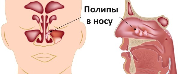 Årsager til blod fra næsen hos voksne: om morgenen, i den normale tilstand ofte eller pludseligt. Førstehjælp og behandling af sygdom