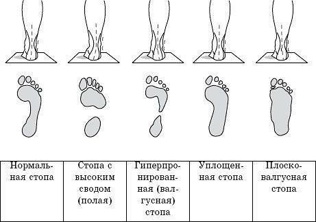 Pied en normal et avec différentes formes de flatfoot