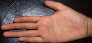 la polyarthrite rhumatoïde enchaînée à la main