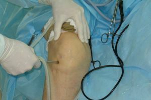 artroscopia del ginocchio