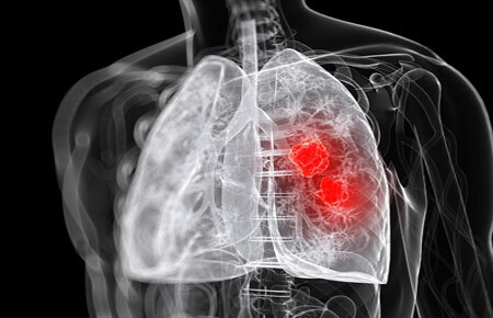 Diagrama pulmonar do abcesso