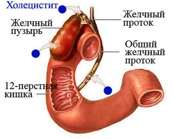 Cholecystitis - inflammation of the gallbladder
