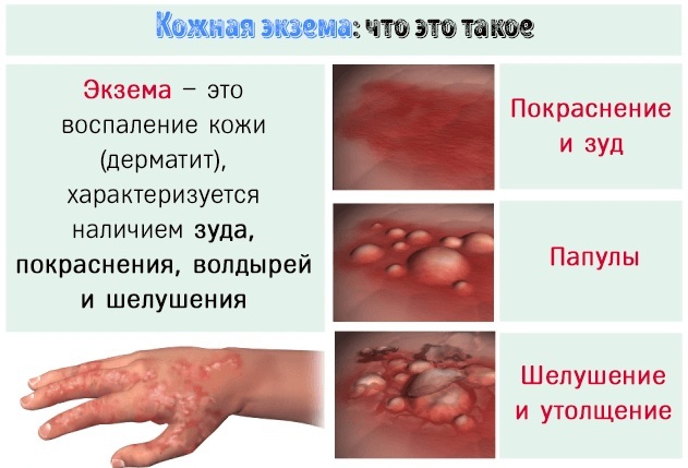 Red pimples on the hands itch, rashes on the fingers, above the elbow. Causes