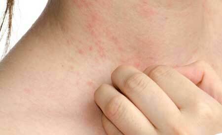 Candidiasis of the skin and mucous membranes: symptoms and treatment, photo