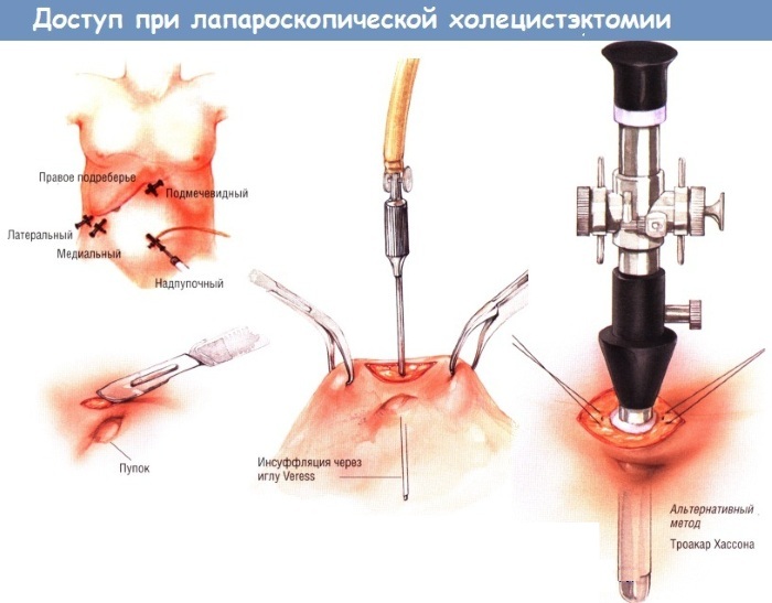 Laparoskopi av gallblåsan. Pris, hur lång, rehabiliteringsperiod, kost
