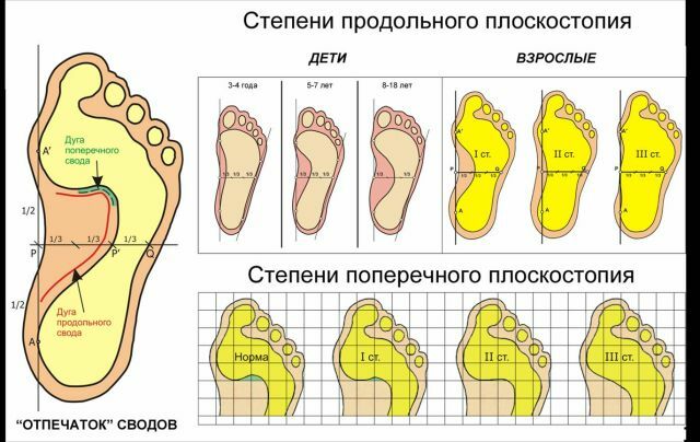 How to check the foot for the presence of flat feet