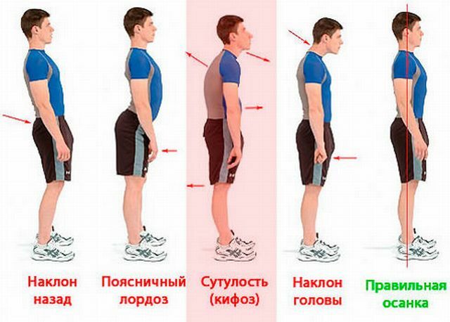 Tipi di curvatura della schiena
