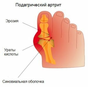 podagra artritas