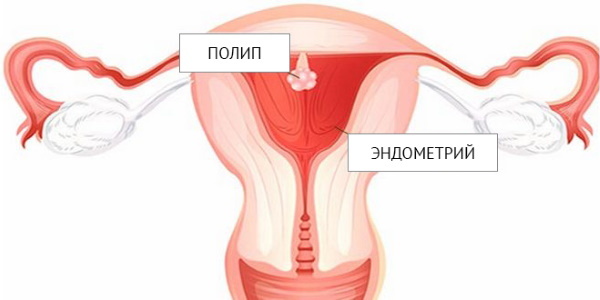 Laser fjernelse af en polyp i livmoderen, endometrie hysteroskopi. Fremstilling, restitutionsperiode