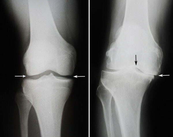 Knee arthroplasty. Price, rehabilitation