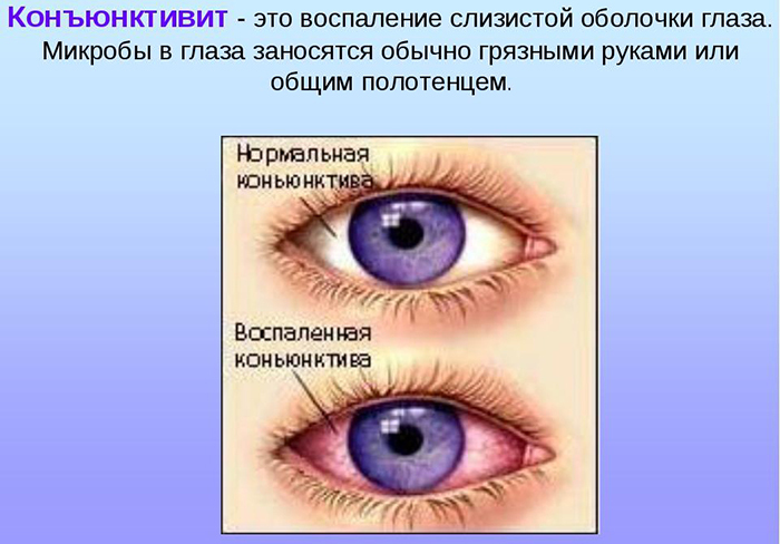 Ciprofloxacin ögondroppar. Bruksanvisning, recensioner