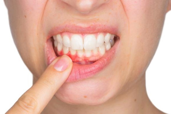 Rotokan (Rotocanum) til skylning af tandkødet i tilfælde af betændelse. Hvordan man opdrætter, ansøgning, pris, anmeldelser