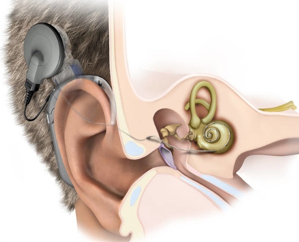 Inflammation (neuritis) of the ear nerve. Symptoms and treatment, signs, causes