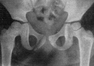 fracture of the pelvic bone