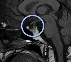 cyste van de hypofyse op een MRI