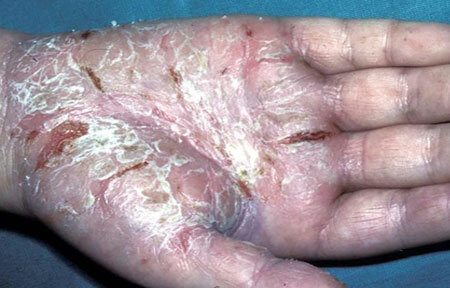 eczema crônica das mãos foto