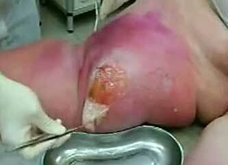 Surgical treatment of erysipelas, photo 7
