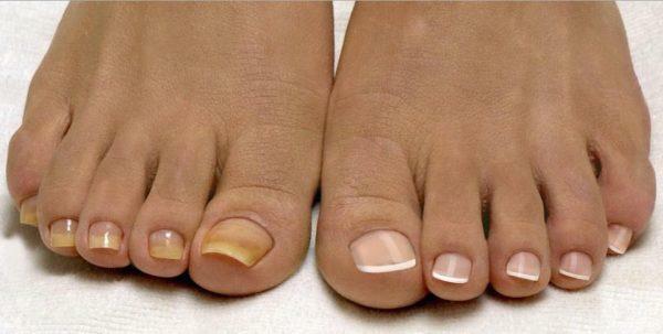 Från en svamp av naglar eller naglar på ben eller fot, vad är det bättre?
